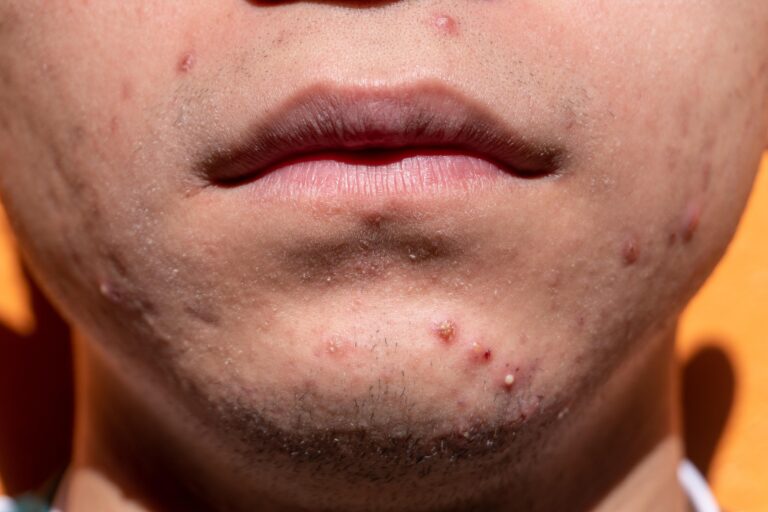 ACNE